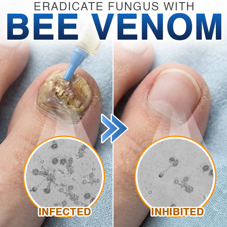 🇦🇺 CareBreeze® Fungi Free Bee Venom Nail Treatment 🩺