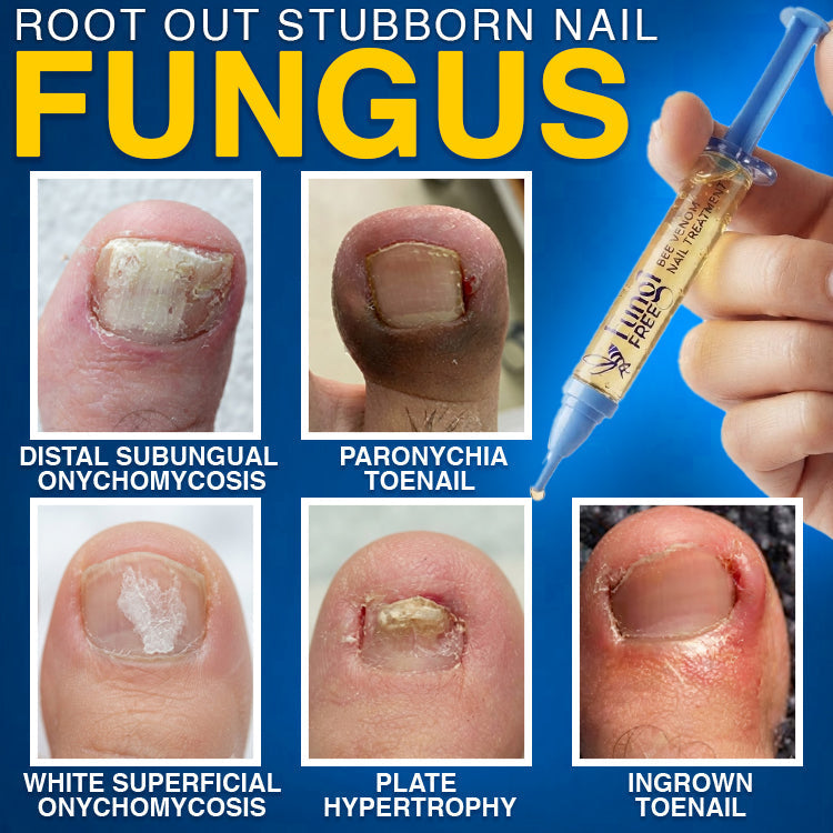 🇦🇺 CareBreeze® Fungi Free Bee Venom Nail Treatment 🩺