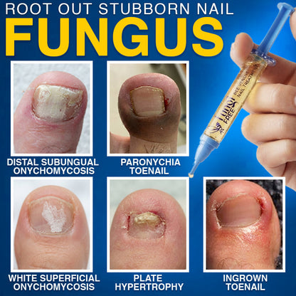 🇦🇺 CareBreeze® Fungi Free Bee Venom Nail Treatment 🩺